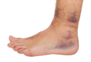 webassets/iStock_000017376113XSmallAnkleSprain.jpg
