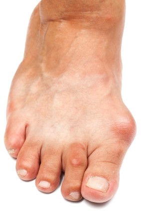 webassets/bunions7.jpg